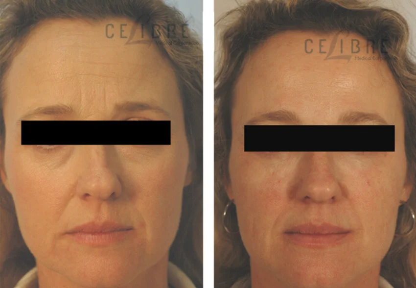 how to prevent eye wrinkles