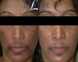 hydroquinone before and after