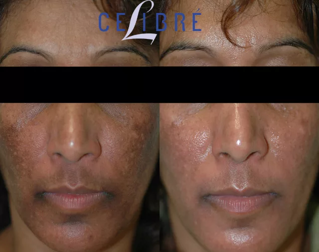 hydroquinone before and after
