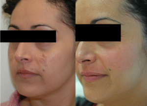 hydroquinone for melasma
