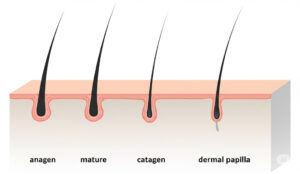 ingrown hair