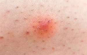 Get Rid of Ingrown Hair