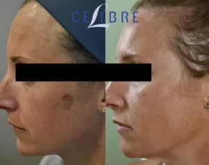 Laser or IPL