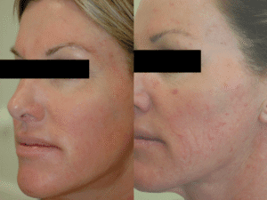 Red Irritated Skin