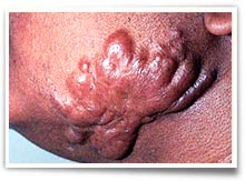 what is a keloid
