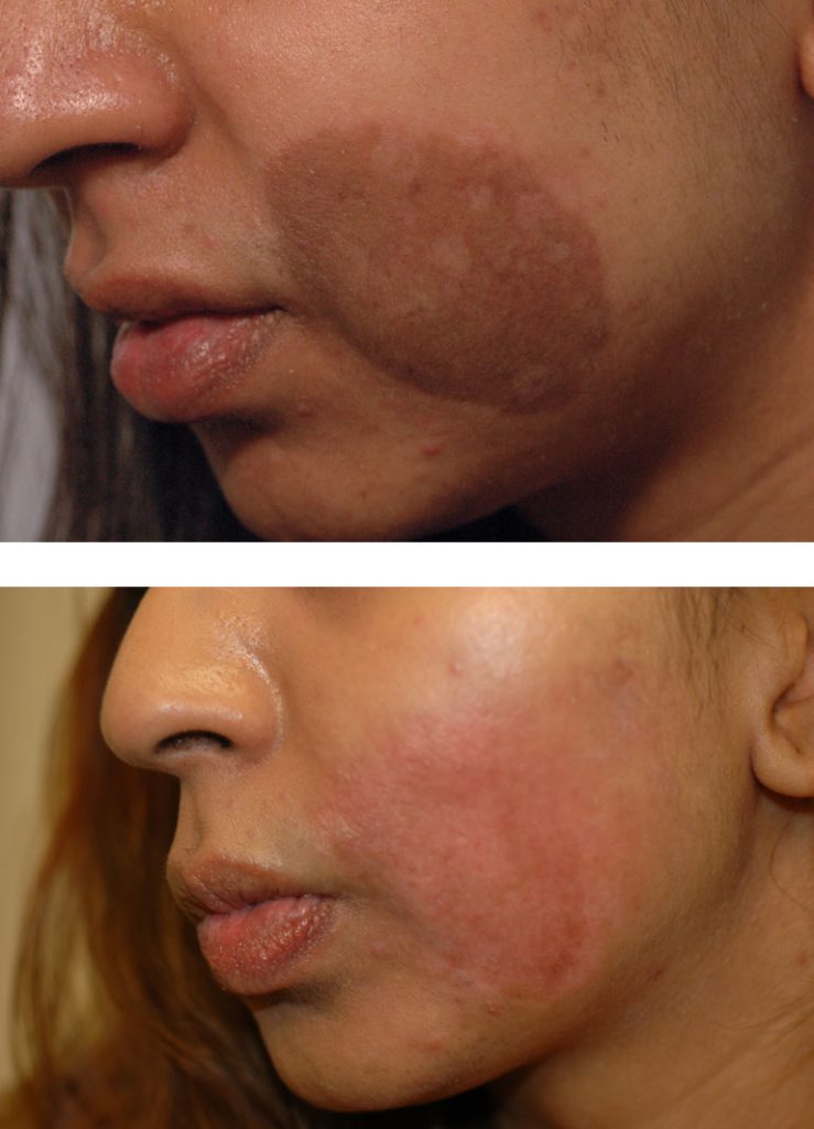 Laser Resurfacing for Birthmark
