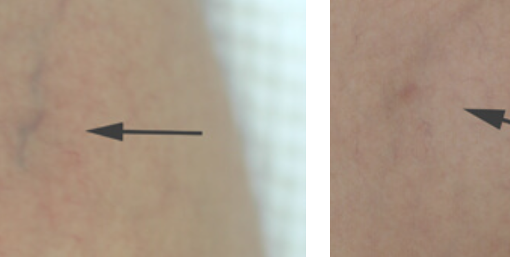 laser for spider veins