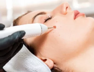 Laser Treatment for Brown Birthmarks