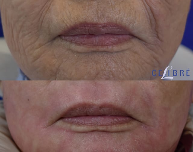 labial melanotic macule removal cost Treatment of labial melanotic macules on the lip. These are benign spots that appear on the lips for no apparent This is a picosecond laser