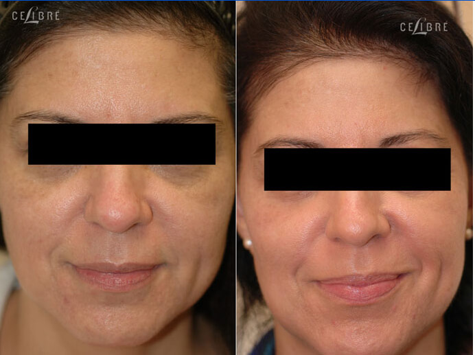 laser skin resurfacing