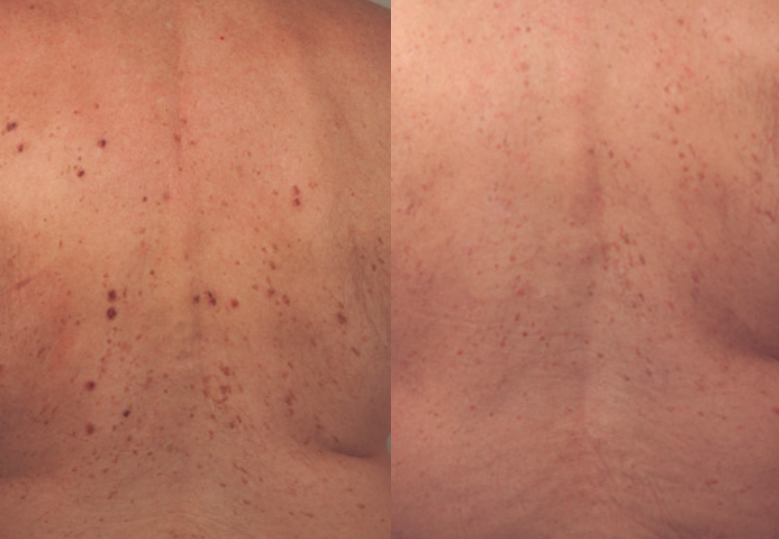 laser sun spot removal