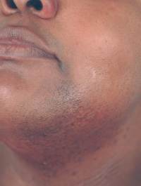 Laser Hair Removal