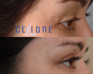 Latisse Side Effects