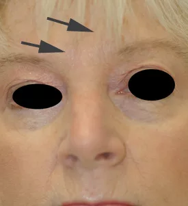 Botox Costs & Treatment