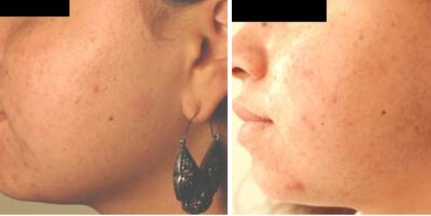 lumenis laser hair removal