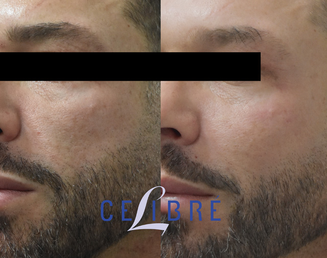 Male patient before and after receiving two vials of Sculptra, showing gradual improvements in facial volume, contour, and overall skin appearance.