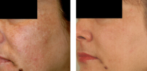 What Causes Melasma