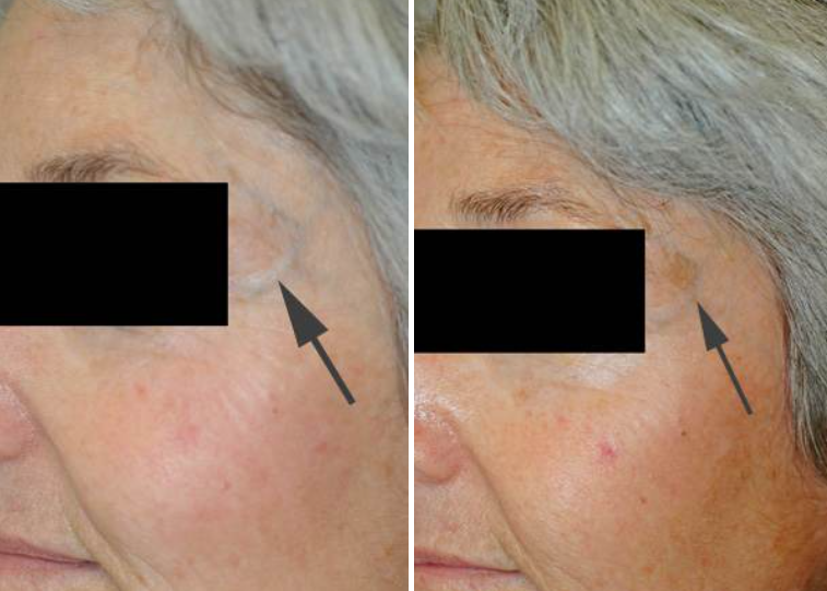 microdermabrasion for age spots