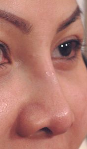 Radiesse Nose Filler