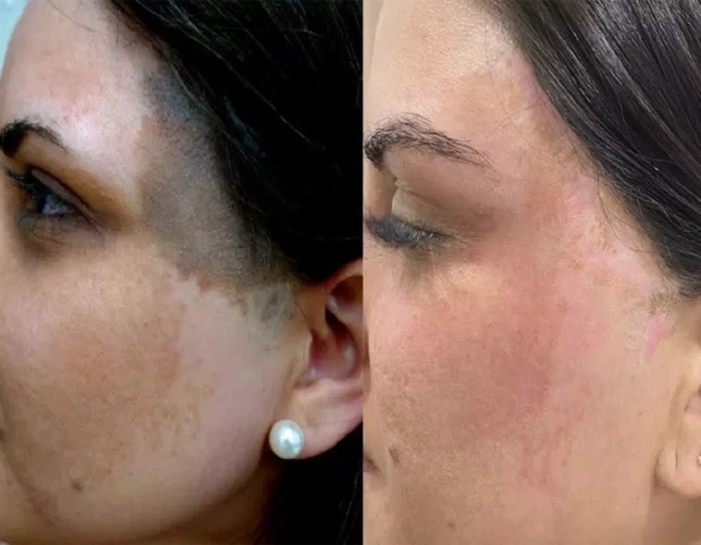 Nevus of Ota