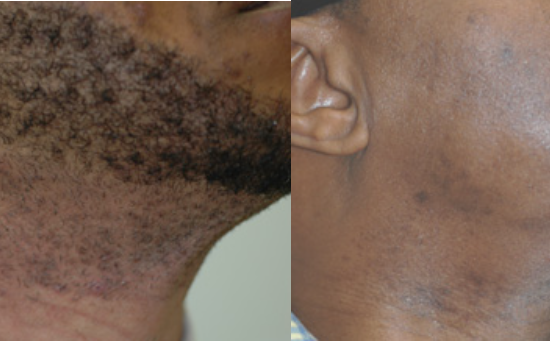 pain free laser hair removal