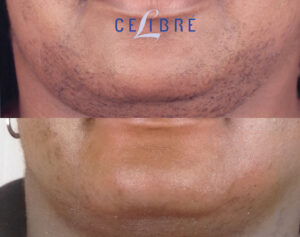 permanent laser hair removal