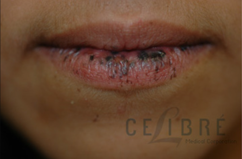 peutz jeghers syndrome lips