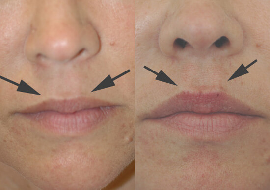 philtrum filler before and after