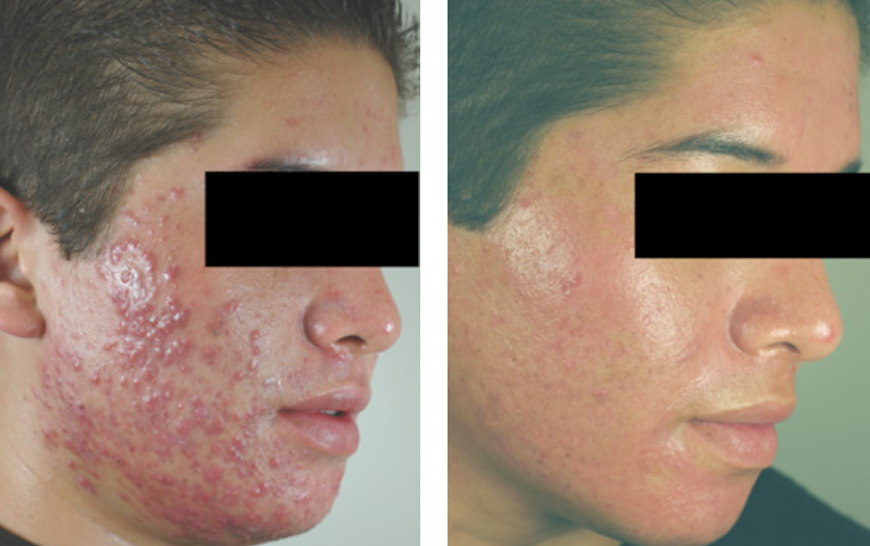 photodynamic therapy acne before and after