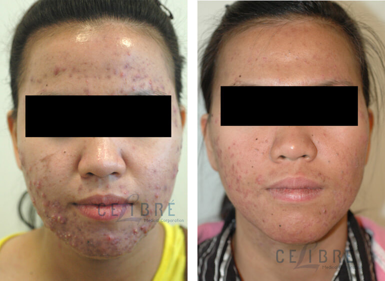 photodynamic therapy