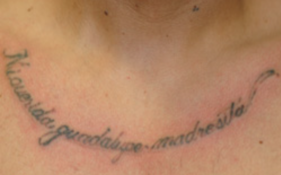 rash after laser tattoo removal