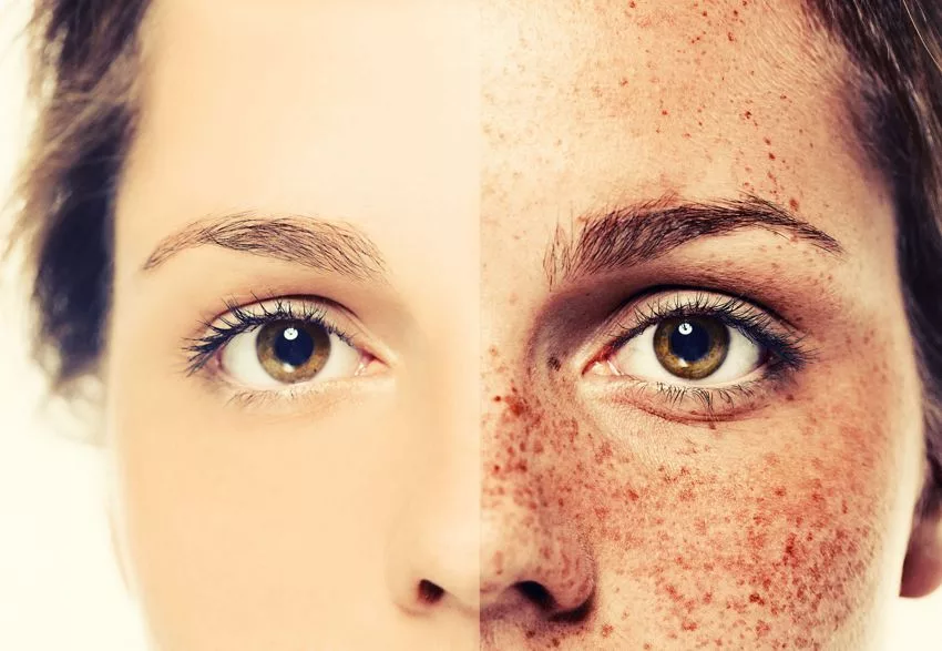 How to Remove Freckles Safely and Effectively