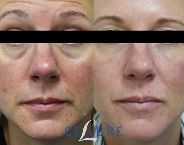 rosacea laser treatment bruising
