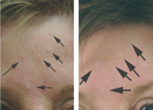 sebaceous hyperplasia