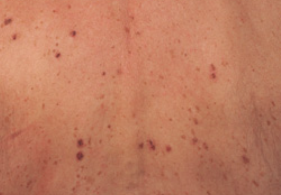 skin cancer from tanning beds