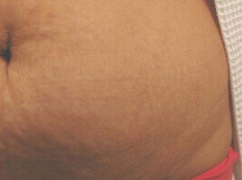 Brown Stretch Marks