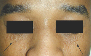 syringomas under eye