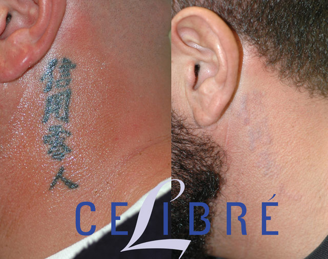 Laser Tattoo Removal Services | Complete Removal | Eyebrow Removal