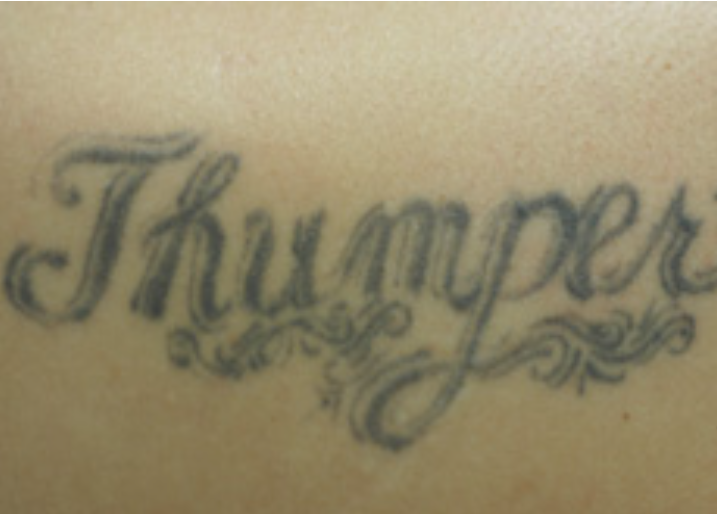 tattoo removal prices