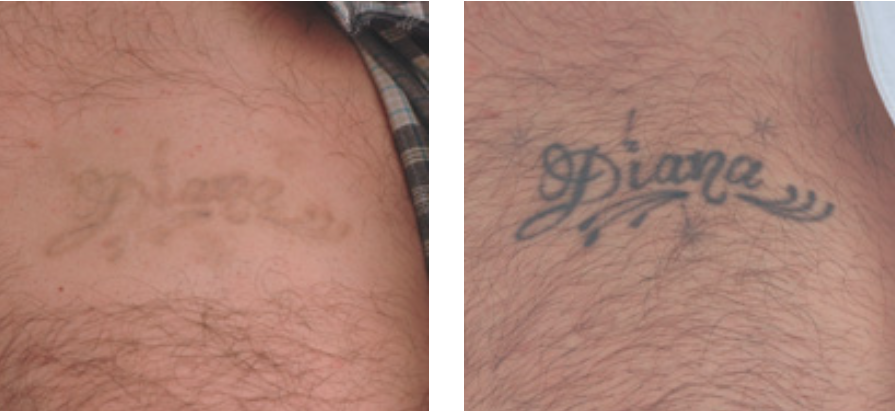 tattoo removal