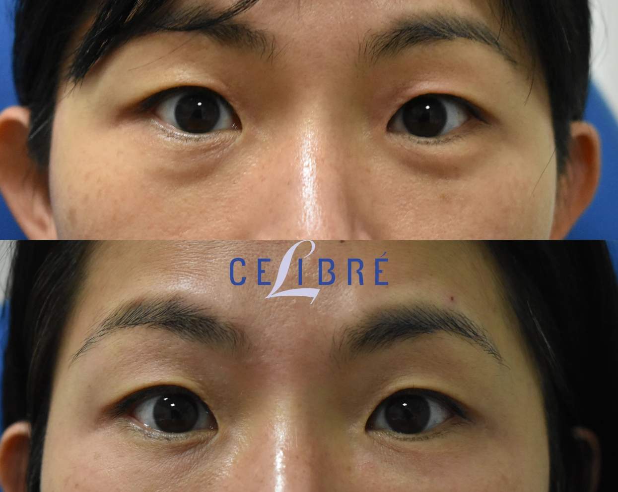 Visible improvement in under-eye tear trough area with long-lasting results shown over a 2-year period.