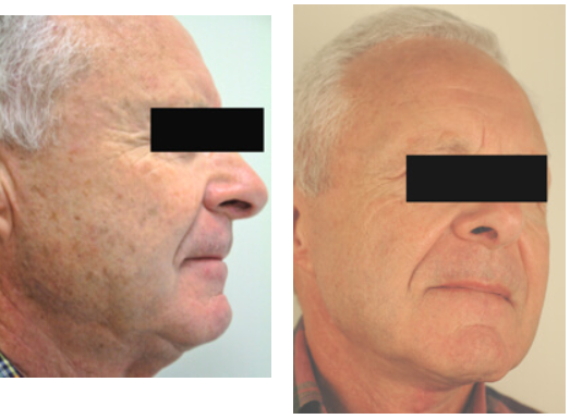 threading hair removal