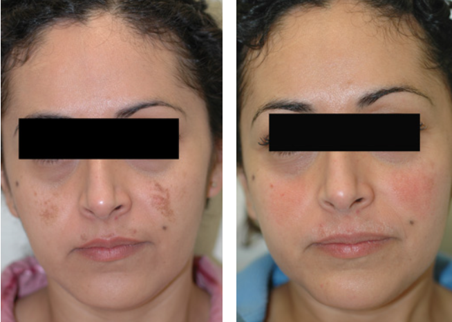 tri luma before and after pictures