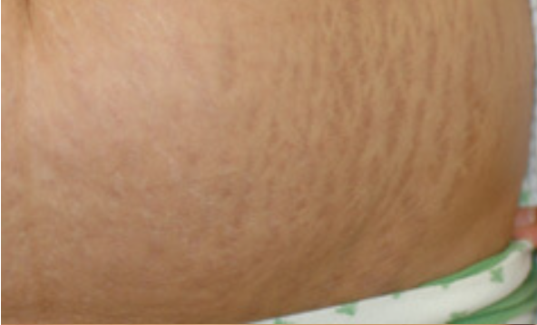 tummy tuck stretch marks