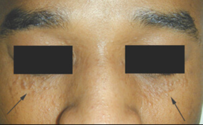 syringoma laser treatment