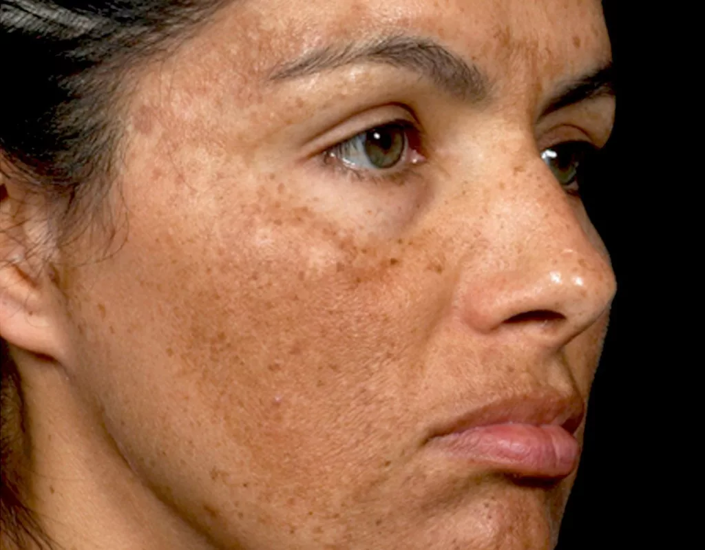 what's melasma
