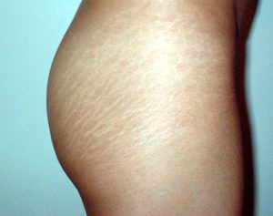 white stretch marks