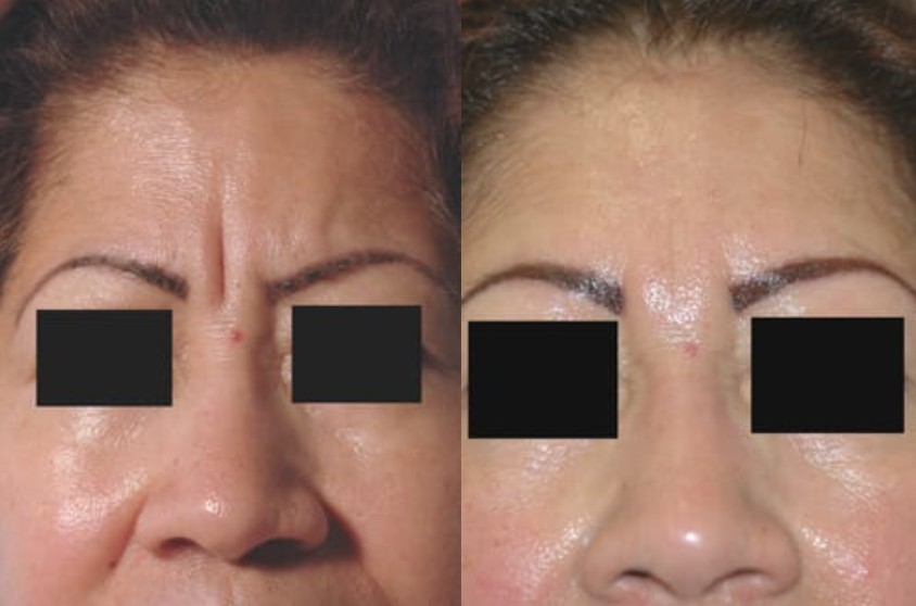 wrinkle between eyebrows